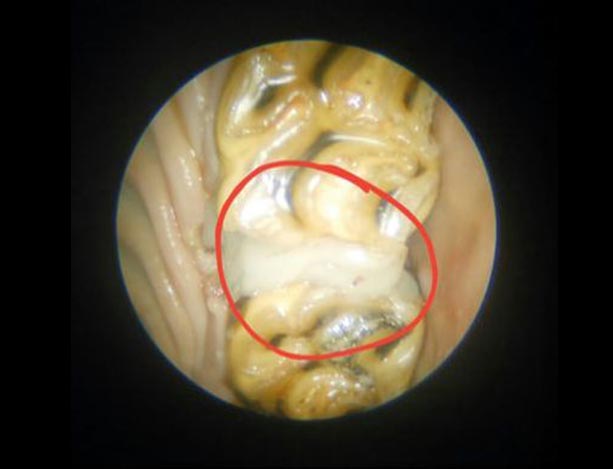 Diastema Widening 4