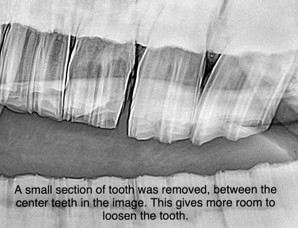 Partial Coronectomy